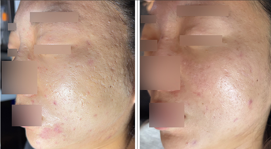청주아이스픽흉터 치료 전후 관자놀이 롤링성흉터