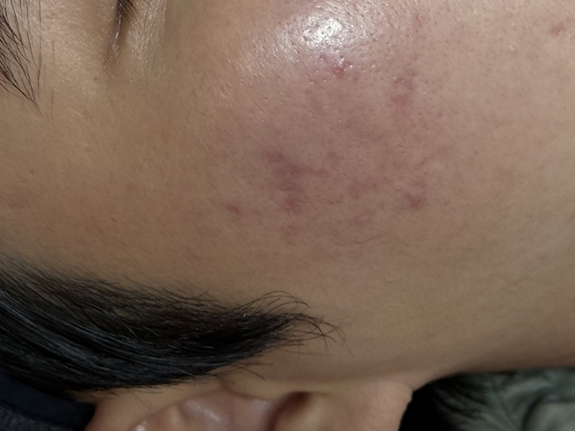 청주박스카흉터 치료 후 우측 뭉친 부위 근접 재생 사진 image7.png	좌측 광대 치료 전후 비교(2단)	청주박스카흉터 치료 전후 좌측 광대 비교 사진 image8.png	우측 치료 전후 비교(2단)	청주박스카흉터 치료 전후 우측 비교 사진 image9.png	우측 뭉친 부위 치료 전후 비교(2단, 근접)	청주박스카흉터 치료 전후 우측 뭉친 부위 근접 비교 사진
