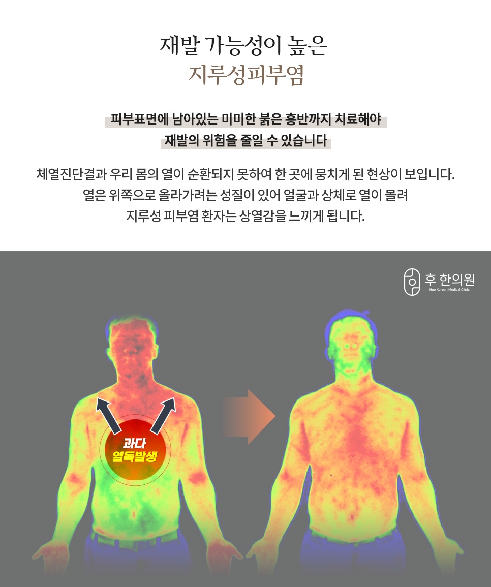 지루성피부염 체열진단 열화상 사진, 얼굴과 상체로 몰리는 열독