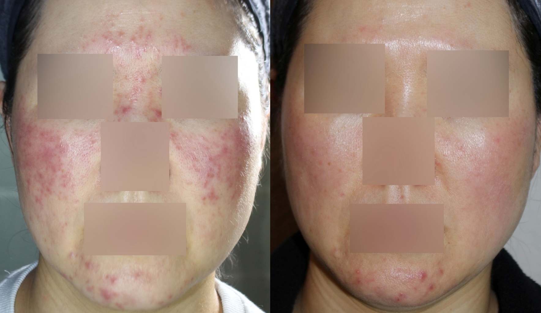 지루성피부염 치료 전후 정면 사진, 전체적인 붉은기 개선 확인