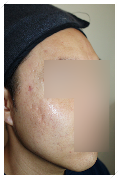 청주여드름흉터 치료 전 광대 관자놀이 롤링성 박스카 흉터 사진
