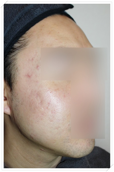 청주여드름흉터 트랜스테라피 엠톤 6회차 치료 후 흉터 개선 사진