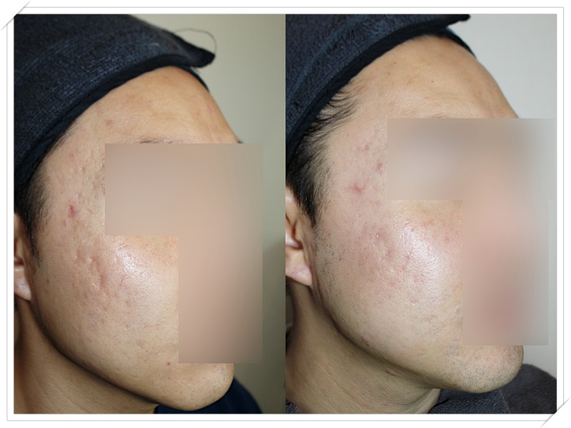 청주여드름흉터 트랜스테라피 치료 전후 비교 사진