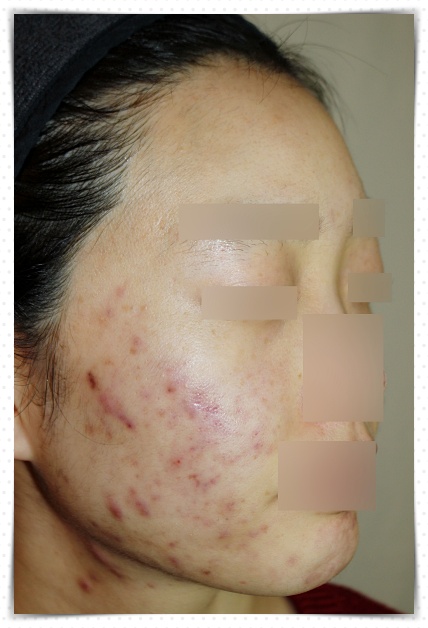 청주성인여드름 치료 전 사진
