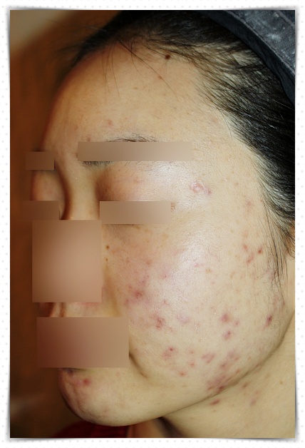 청주성인여드름 치료 전 좌측 사진