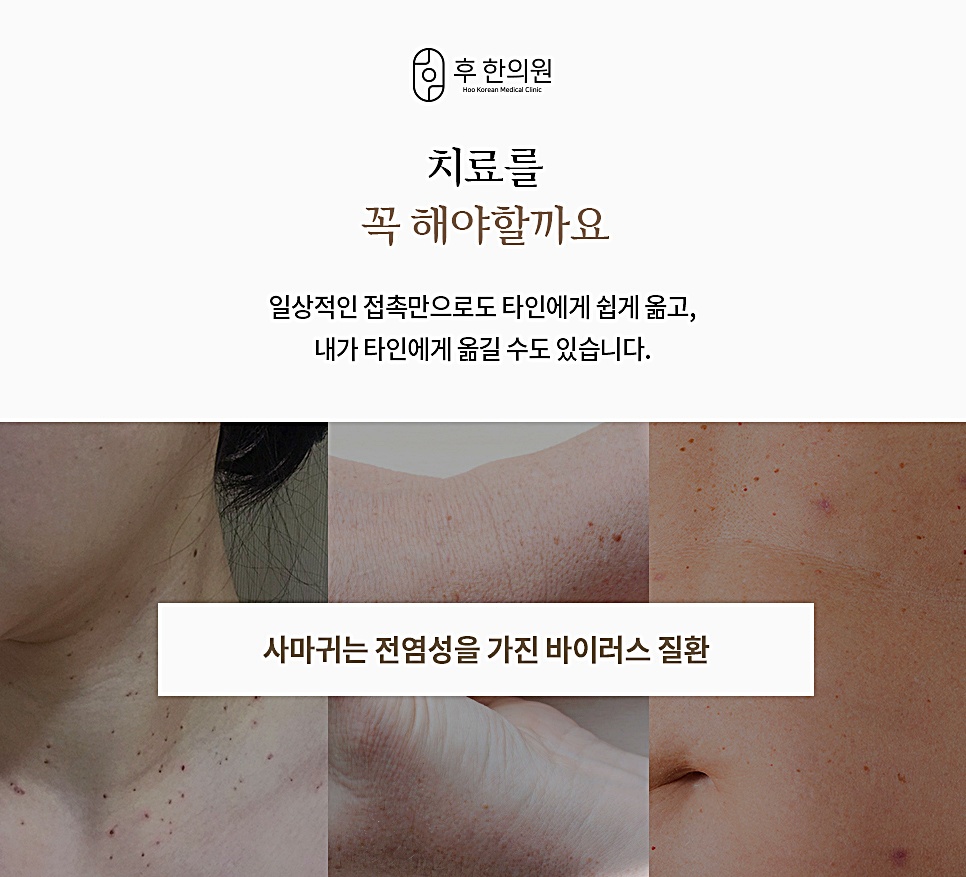 편평사마귀가 전염성 바이러스 질환임을 보여주는 피부 접촉 부위 사진