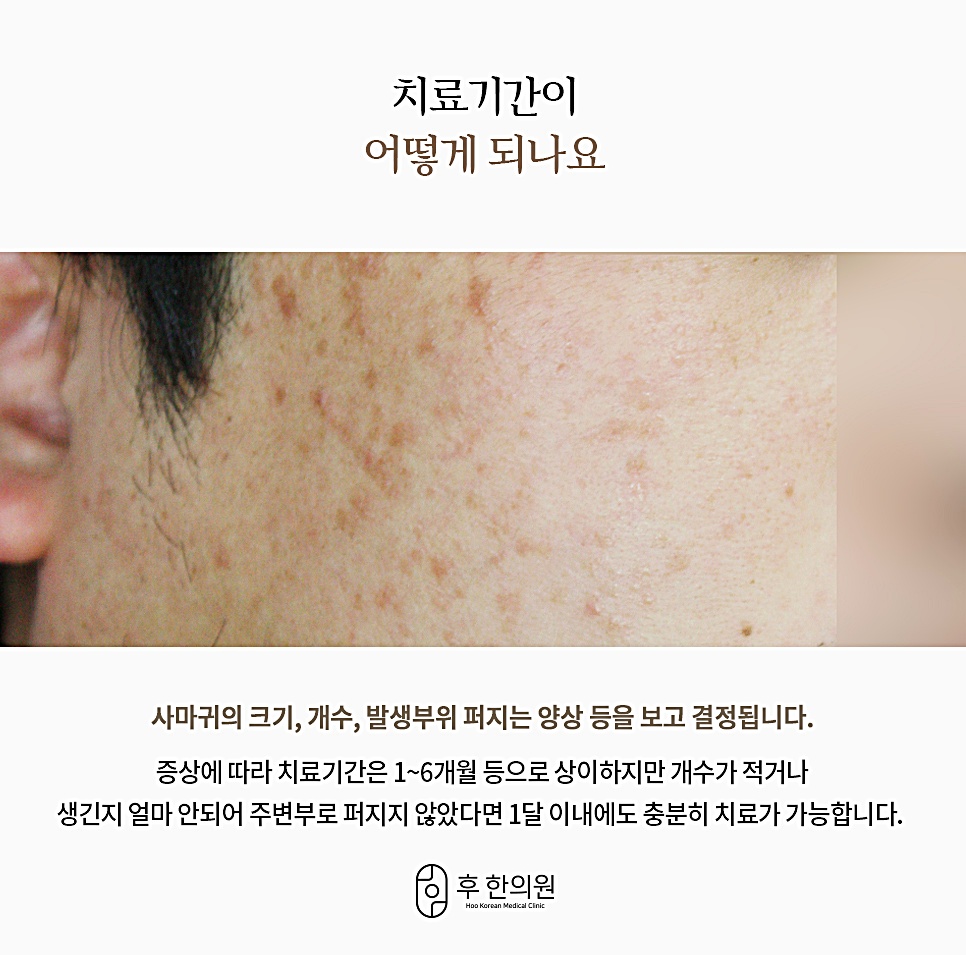 편평사마귀 치료기간을 설명하는 볼 부위 사마귀 병변 클로즈업 사진