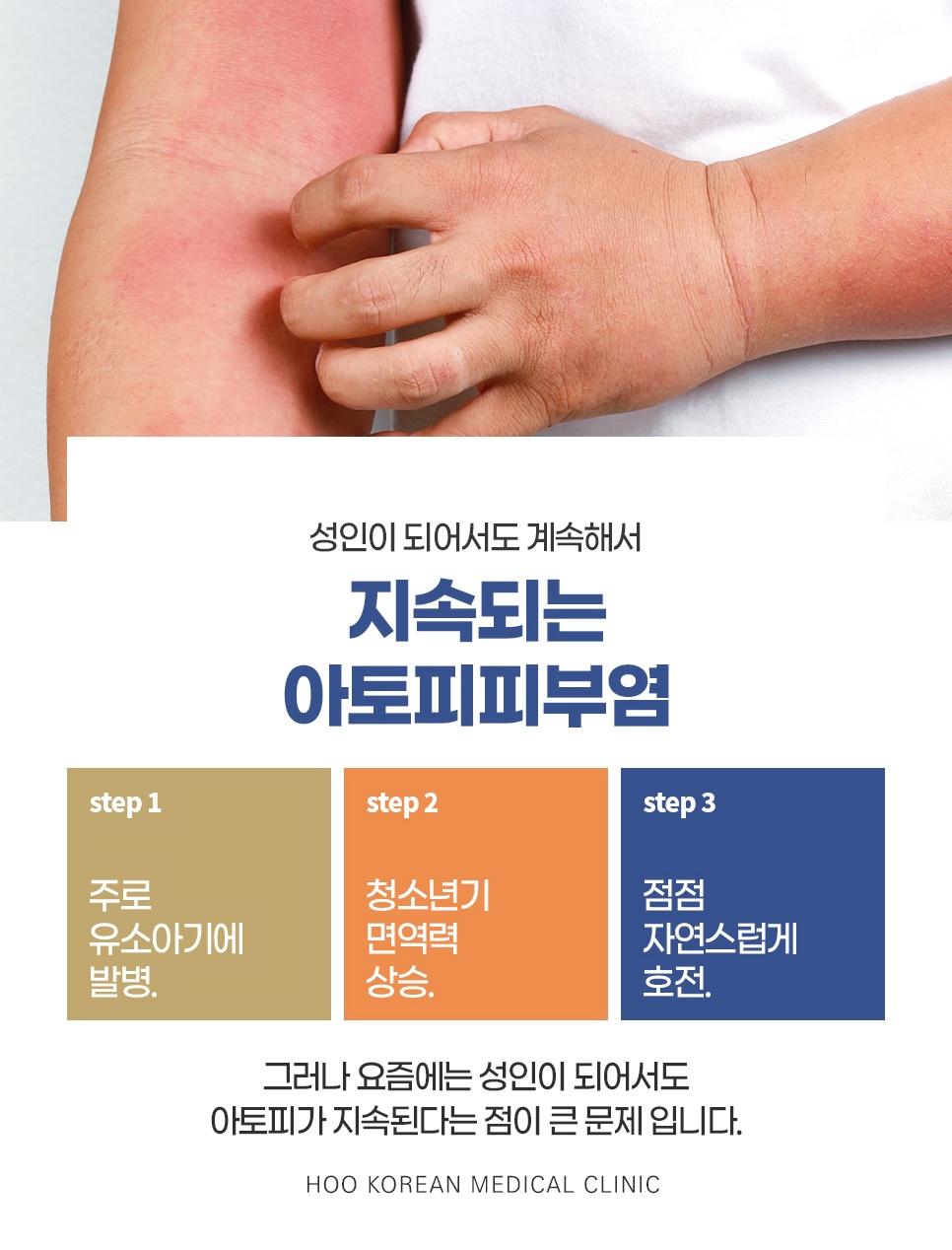 성인이 되어도 지속되는 아토피피부염의 발병 단계별 설명