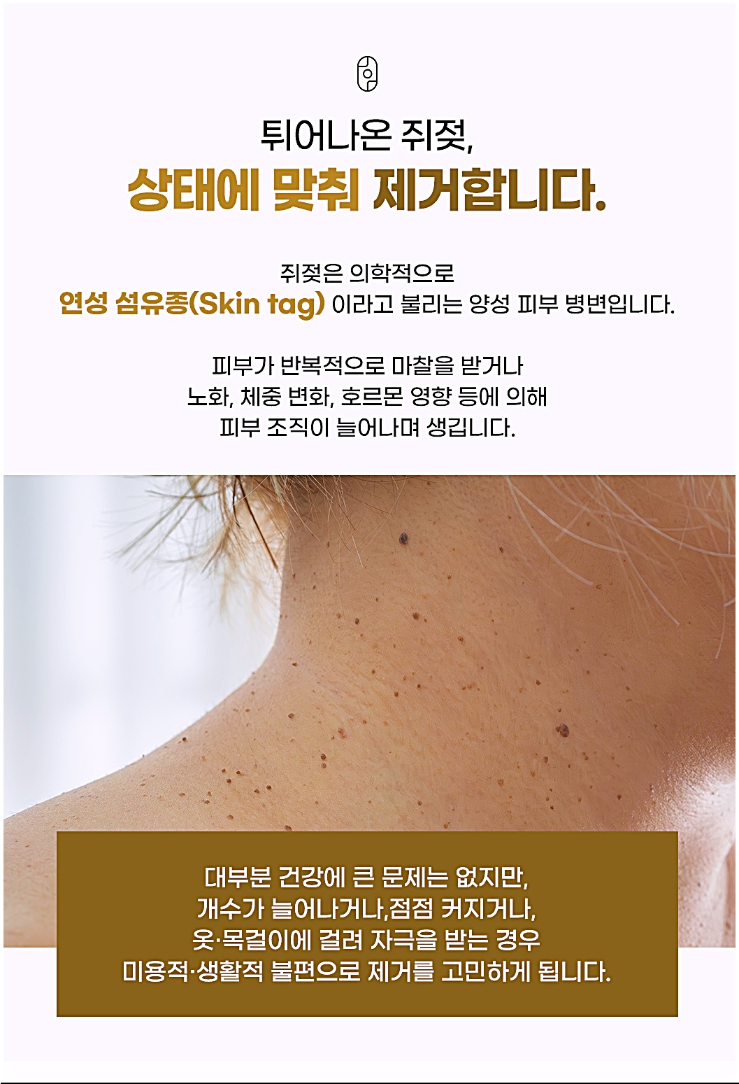 여러 개 자리한 연성 섬유종(쥐젖), 마찰과 호르몬 영향으로 생기는 양성 피부 병변