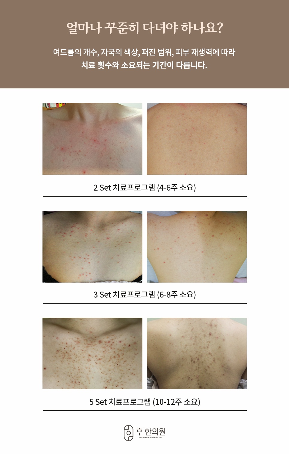 등가슴 여드름 치료 기간 및 2Set, 3Set, 5Set 치료 프로그램 비교