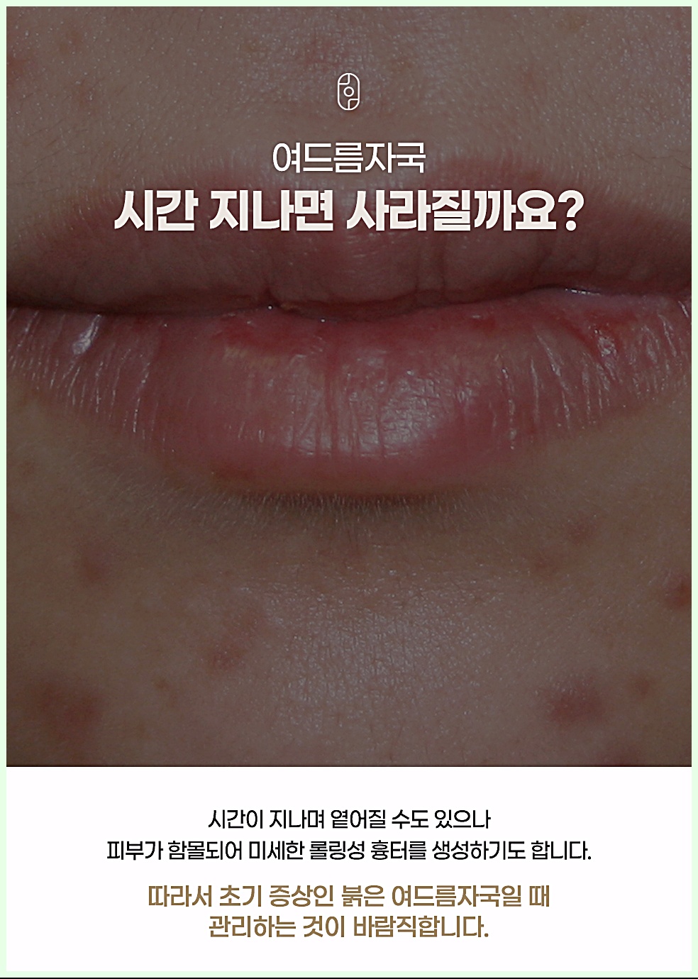 여드름자국 시간 지나면 사라질까요 - 진피층 손상 시 롤링성 흉터로 남을 수 있다