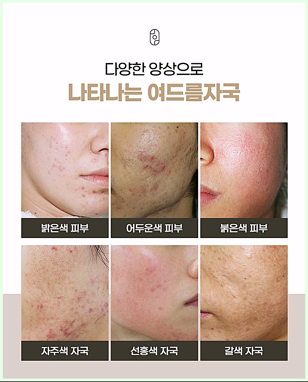 다양한 양상으로 나타나는 여드름자국 - 피부 톤과 자국 색상(자주색·선홍색·갈색)별 비교