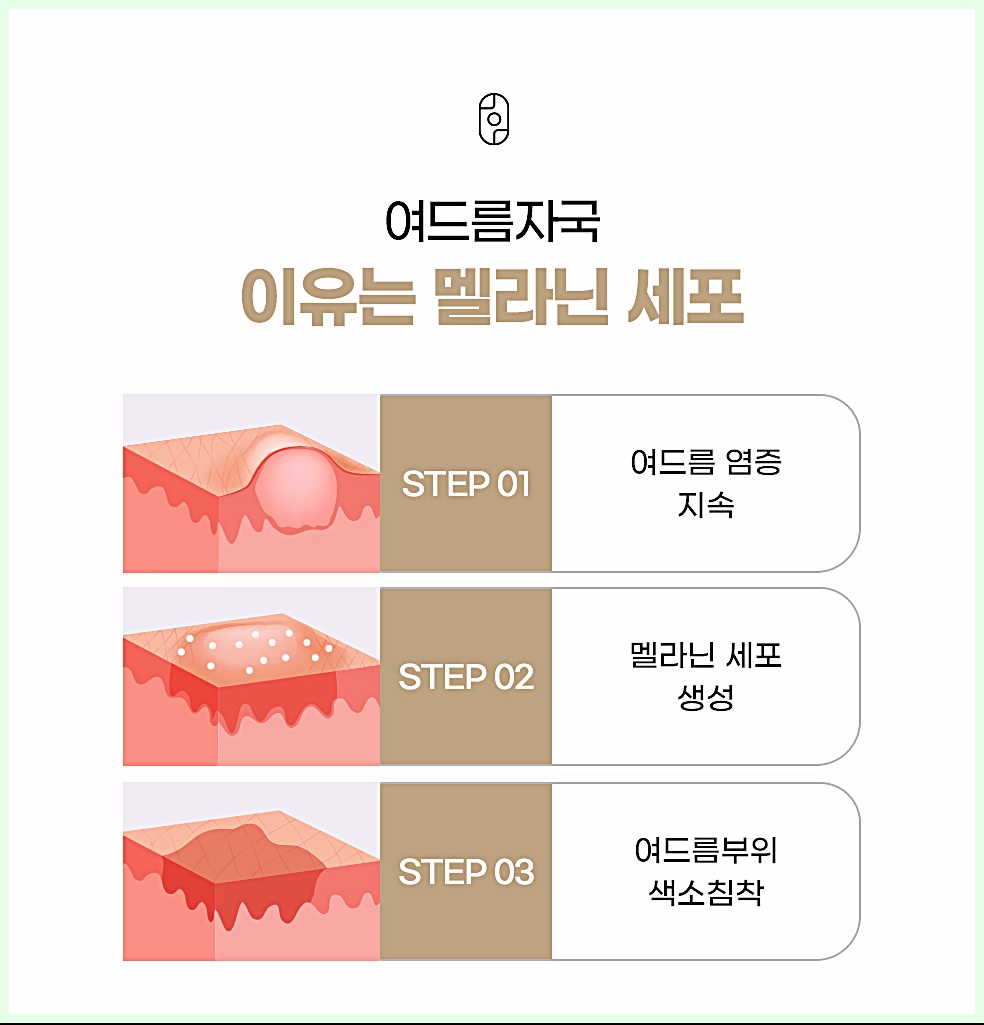 여드름자국 이유는 멜라닌 세포 - 염증 지속부터 색소침착까지 자국 생성 원리