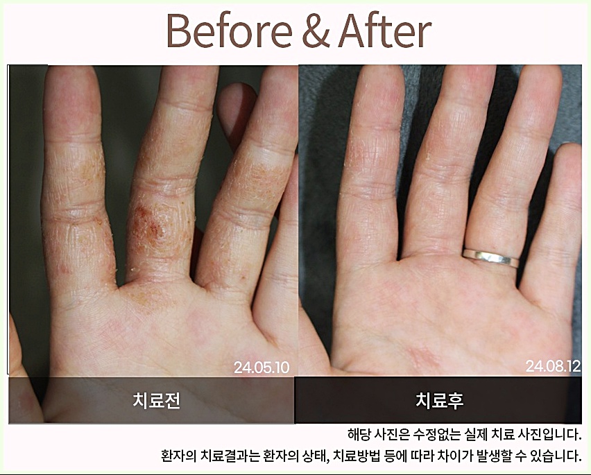 청주습진치료 손습진 치료 3개월 전후 비교 사진
