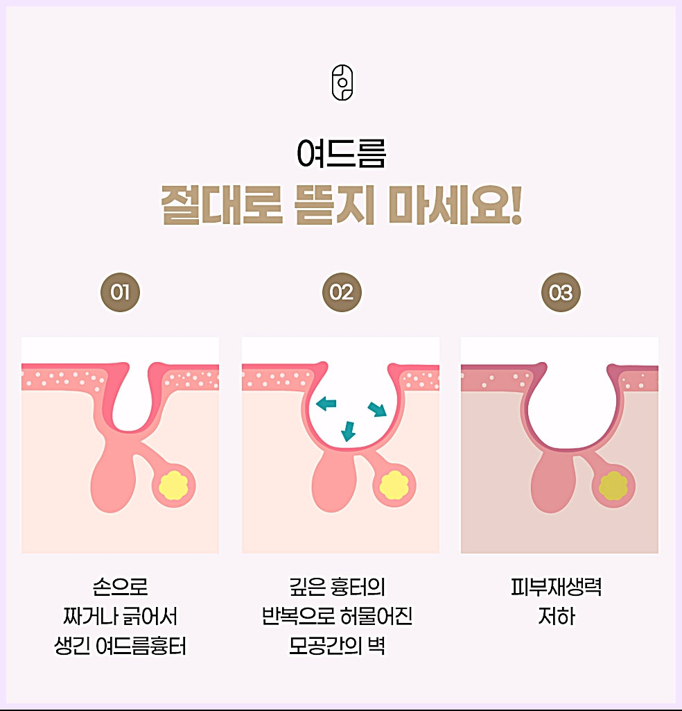 손으로 짜거나 긁어서 생긴 여드름 흉터가 모공 사이 벽과 피부 재생력에 영향을 주는 과정