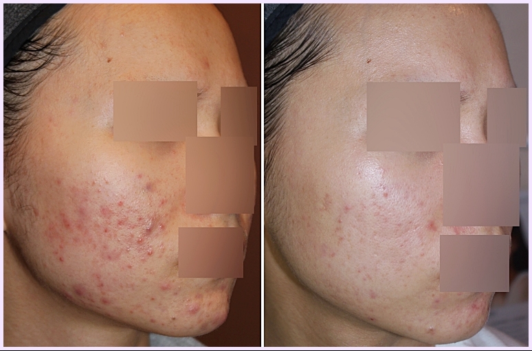 청주여드름피부과 후한의원 청주점 여드름 치료 2개월 전후 사진, 볼과 턱선의 붉은 병변 변화 비교