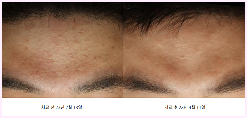 편평사마귀 이마 제거 전후