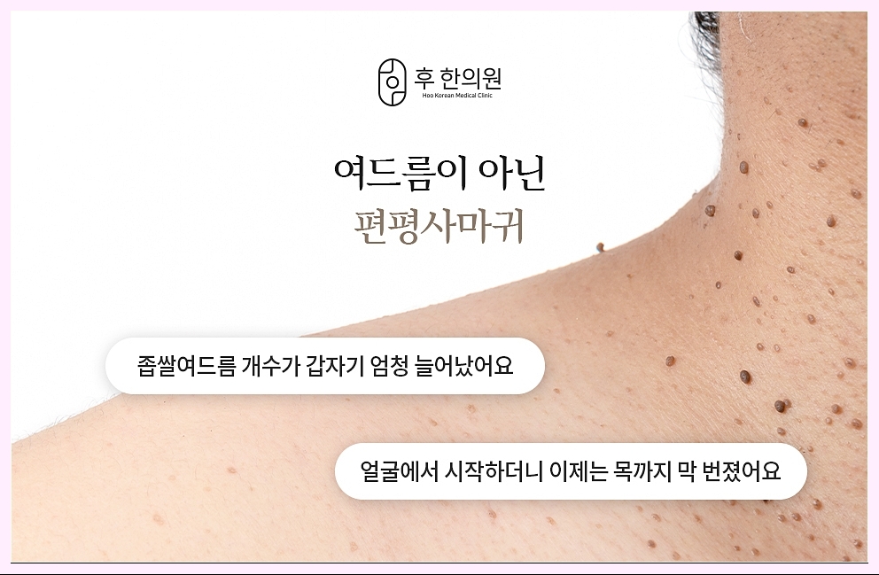 편평사마귀의 정의 이미지