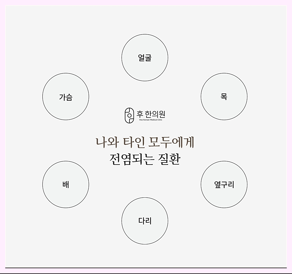 편평사마귀의 전염성