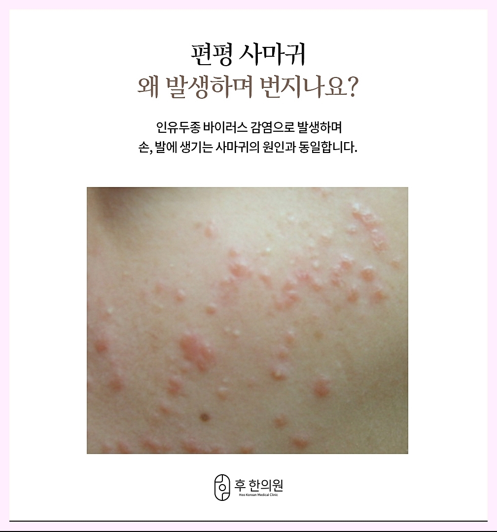 편평사마귀가 번지는 이유에 대한 이미지