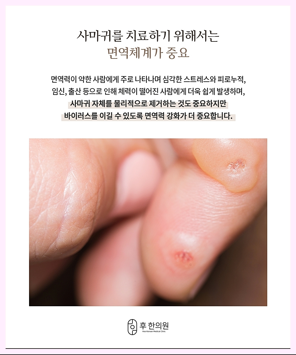 편평사마귀에 중요한 것은 면역력