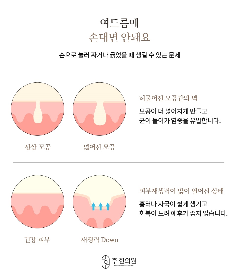 손으로 짜거나 긁었을 때 모공이 넓어지고 재생력이 떨어지는 과정 비교