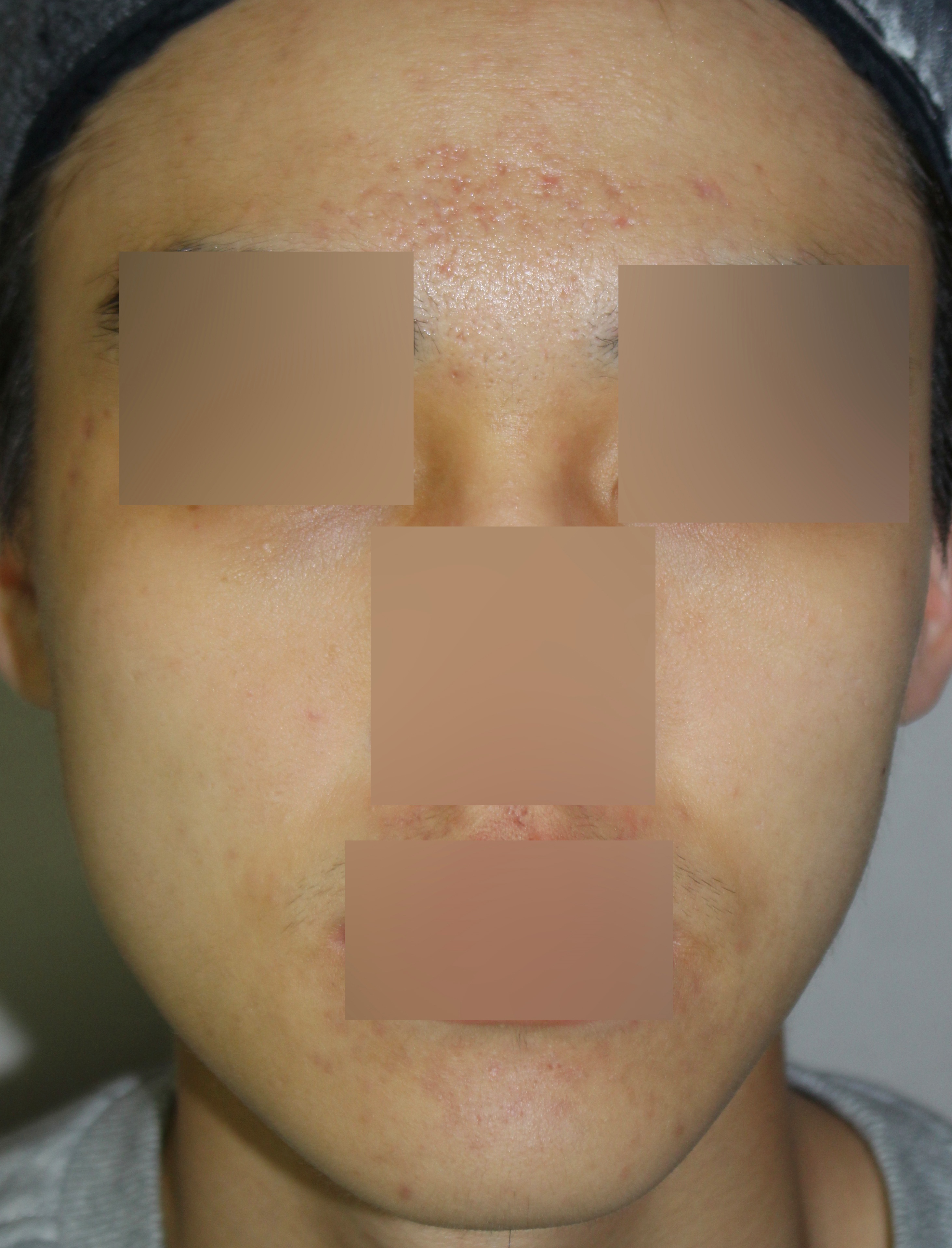 이마의 작은 돌기만 남고 전체 피부톤이 고르게 보이는 치료 후 정면 사진