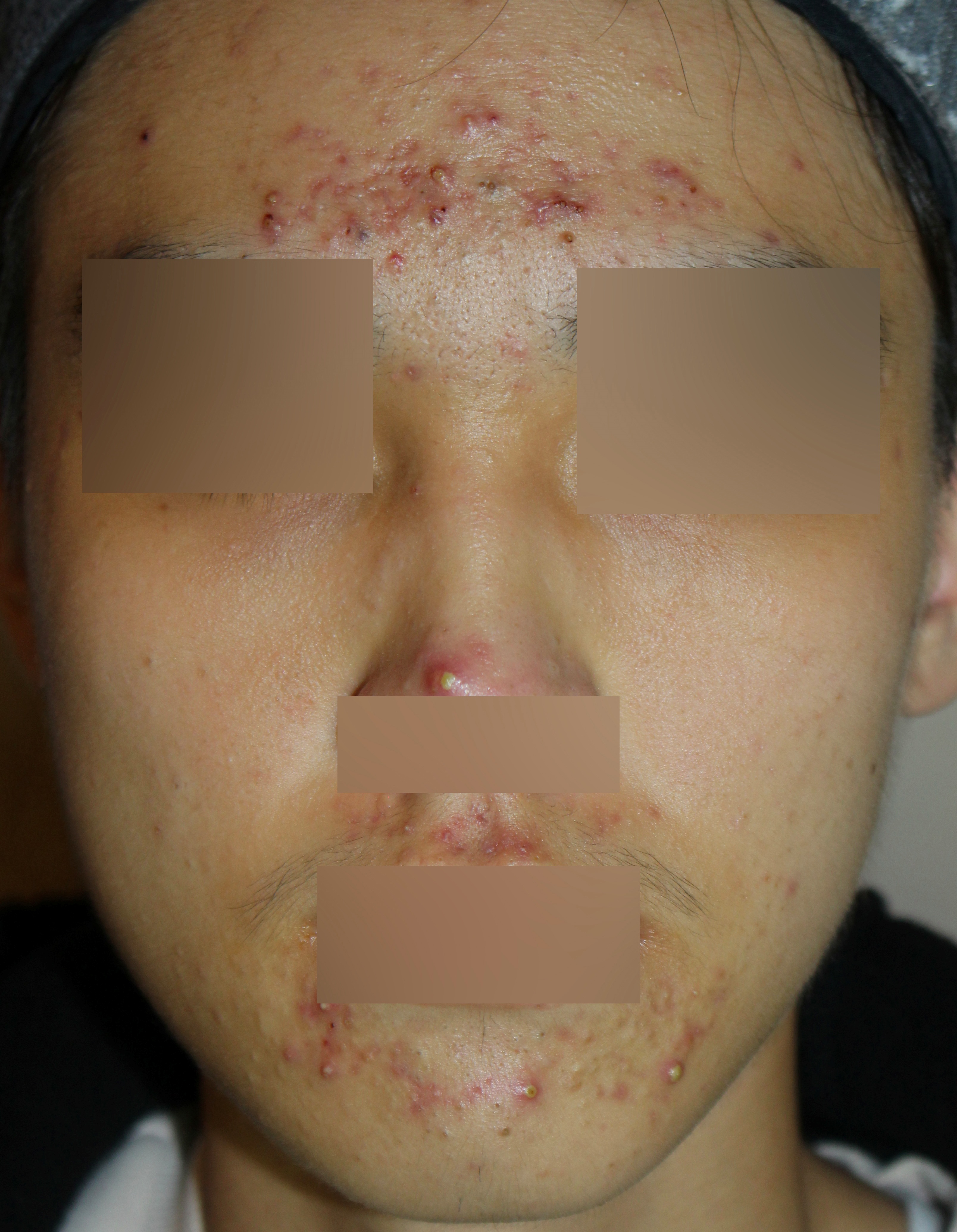 이마와 코, 입 주변에 붉은 농포가 몰려 있던 치료 전 정면 사진