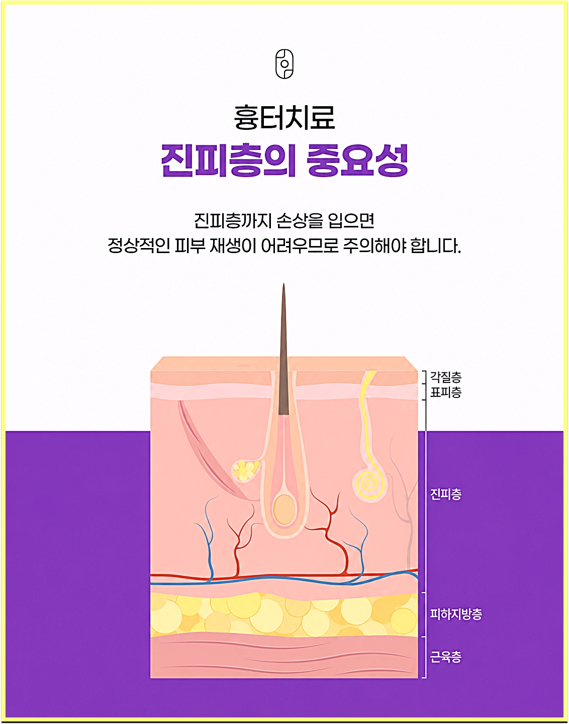 여드름흉터 치료에서 진피층의 중요성을 설명한 피부 구조 안내