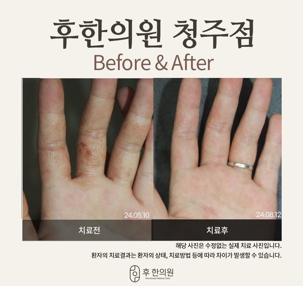 손가락 습진 치료 2개월 전후 경과